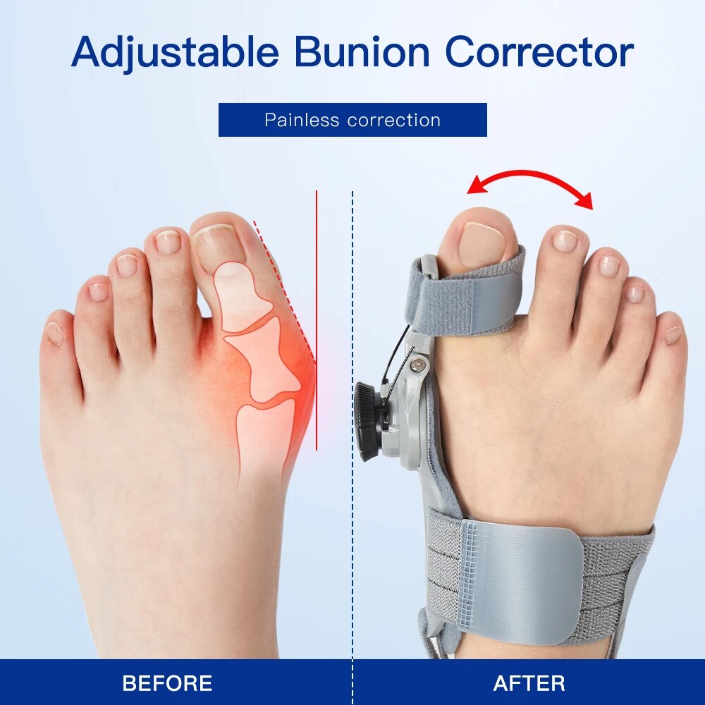 Vantage™ Bunion Fix – Effortless Bunion Relief at Home